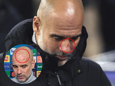 Pep Guardiola apareció lleno de rasguños luego del papelón de Manchester City