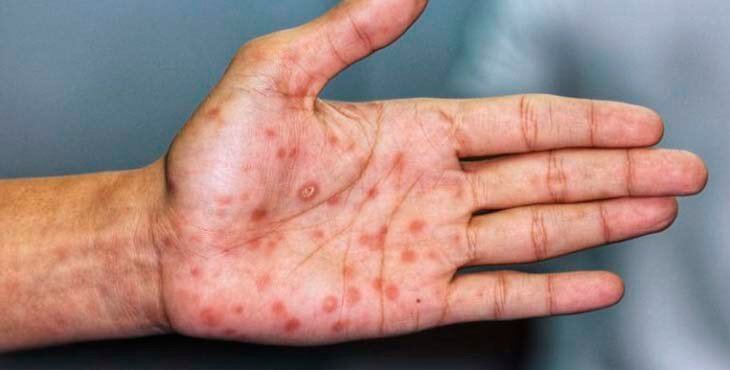 Estudian un segundo caso sospechoso de viruela del mono en Argentina